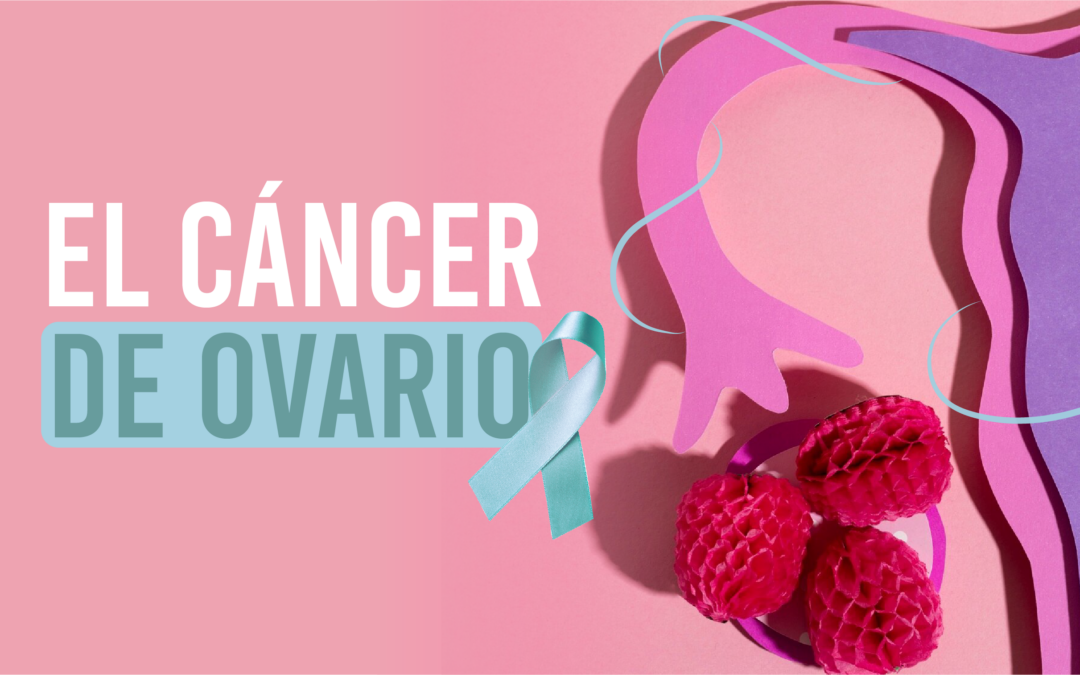 Todo lo que Necesitas Saber sobre el Cáncer de Ovario