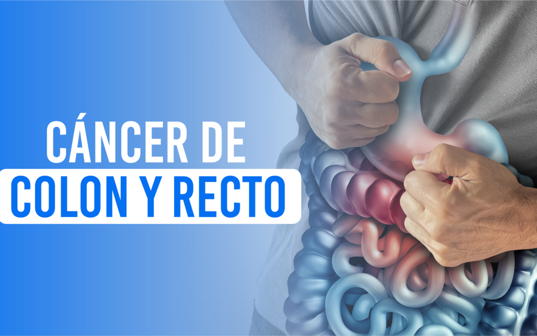 Cáncer de Colon y Recto: Conoce los Riesgos y Cómo Detectarlo a Tiempo
